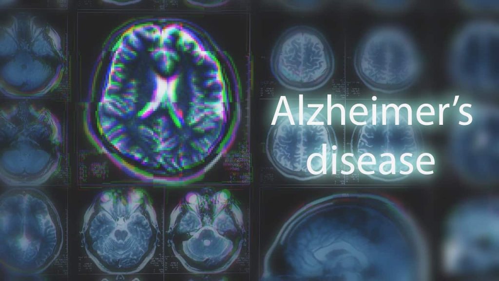 doenca de alzheimer