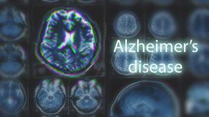 Remédio retarda avanço do Alzheimer em 60%